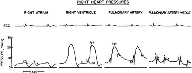 Pulmonary+artery+pressure+waveform