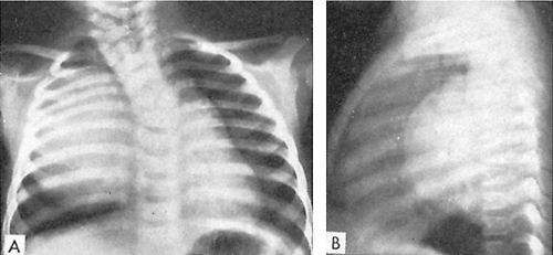 165 - Acute and Chronic Mediastinal Infections | General Thoracic ...